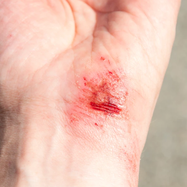 Deep wound