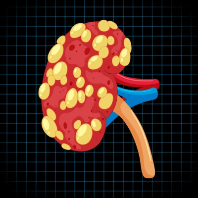 Kidney Cancer