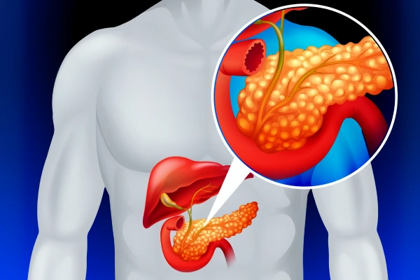 Pancreatitis Pancreatitis