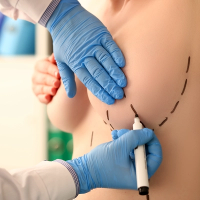 General & Laparoscopic-Breast Lump Surgery General & Laparoscopic-Breast Lump Surgery